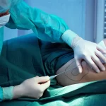 Liposuction Surgery in Ludhiana